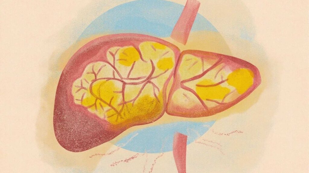 Autoimmune hepatitis