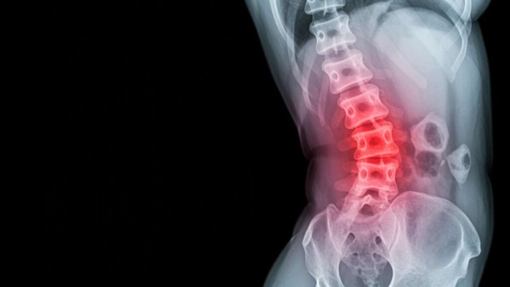 ankylosing spondylitis symptoms, causes and treatment